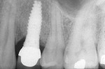 Figure 10  Radiograph demonstrating localized bone loss associated with retained cement on the mesial aspect of implant abutment. Bone loss was only noted on mesial where cement was found; no bone loss was noted on distal where cement was absent. (Ac