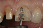 Figure 6 Here, a conventional 0.5-mm/0.7-mm/0.9-mm bur was used directly on the labial aspect of the tooth.
