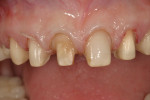 Figure 10 In this case, the final preparation finish line extended interproximally to the palatal aspect of the tooth to accomplish the tooth morphology changes that were required to achieve the desired final outcome.