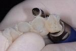 Figure 6 The buccal and palatal margins were
trimmed first using any of the three rotary instruments.