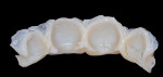 Figure 5 The initial provisional restoration prior to trimming. The provisional was made with a direct technique using a clear matrix taken from the diagnostic
wax-up.