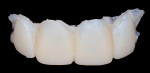 Figure 4 The initial provisional restoration prior to trimming. The provisional was made with a direct technique using a clear matrix taken from the diagnostic