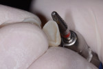Figure 7 The buccal and palatal margins were
trimmed first using any of the three rotary instruments.