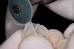 Figure 8 The buccal and palatal margins were
trimmed first using any of the three rotary instruments.