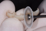 Figure 10 The gingival embrasures were opened first using a thin, flexible disc that was run at a slower speed.