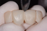 Figure 13 The same discs could be used to carve the facial and incisal embrasures to create the line angles.