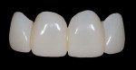 Figure 19 The completed provisional restorations after finishing and polishing.
