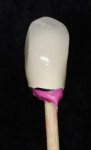 Figure 14  Cementation technique of creating a duplicate abutment using dense bite registration paste within the implant crown. Duplicate abutment created