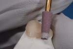 Figure 15 Refining adjustment of full zirconia crown with Dialite ZR Medium Grinder.