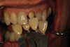 (6)  Incipient decay on tooth No. 20.