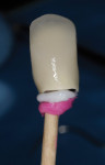 Figure 16  Cementation technique of creating a duplicate abutment using dense bite registration paste within the implant crown. The duplicate abutment was inserted to express the excess cement, leaving a thin film of cement within the crown for final