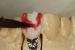 Grey translucency overlay was applied over the mesial, distal, and body areas.