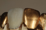 Renfert gold die spacer was used to create the final texture on the surface.