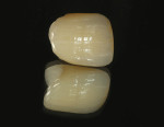 Irregular surface texture between incisal area crack line and mamelon can be seen.