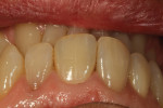 An occlusal view with dehydration.
