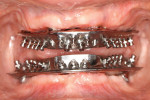 Facial view of the maxillary and mandibular Montreal milled bars at try-in stage. Note the external labial and buccal finish lines in relation to residual ridge.