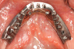 An occlusal view of mandibular Montreal bar. Note buccal to lingual relationship
of titanium bar to residual ridge.
