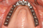 An occlusal view of the maxillary Montreal bar; the labial aspect of bar is where modification is necessary.