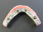 Intaglio view of the mandibular before the metal was cut back.