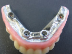 Intaglio view of the mandibular after the metal was cut back to re-create external finish line.