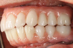 A left buccal view of the completed composite build-up of a re-contoured gingival extension.