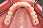 An occlusal view of the maxillary finished hybrid. Compare the labial and buccal extension to the bar in Figure 3.