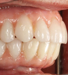 A buccal view of the anterior segment. Note the mandibular gingival transition and maxillary relation to lip.