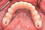 An occlusal view of the mandibular finished hybrid. Compare the labial and buccal extensions to the bar in Figure 2.