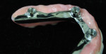 An intaglio view of the finished maxillary. The left side shows the re-contoured metal and composite borders.