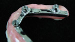 An intaglio view of the maxillary right side showing re-contoured metal and composite borders.