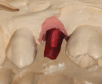 The titanium abutment with waxing channel was placed on the model before creating the abutment wax-up.