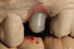 The pressed abutment was characterized using IPS e.max stains.