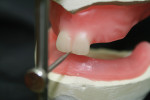 Two upper centrals were placed in the rim so that the midline and the incisal edge touched the pin.