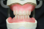 Remaining anterior teeth were set.
