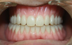 The technician’s objective was to replace what the patient originally possessed in terms of teeth, gums, and bone.