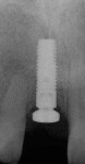 Figure 6  Radiograph of the implant placed in the regenerated area.