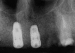 Figure 12  Radiograph of the implants in the central incisor area.