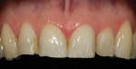 Figure 3  1:1 magnification of the anterior teeth discloses attrition and compromised restorations.