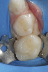 Figure 1 Preoperative photograph, Case 1, showing interproximal decay on the distal of the first primary molar and the mesial of the second primary molar