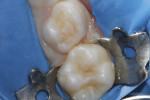 Figure 2 Preoperative photograph, Case 2, showing decay on the first and second maxillary primary molars, with decay on the first molar extending into the pulp.