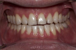 Figure 9. Completion of orthodontic therapy 8 months after initiation of orthodontia; transitional bonding remained in place.