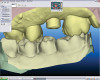 Fig 4. Tooth preparations and final design of the restorations in the initial software.