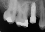 Figure 3. Six-month post implant placement with BellaTek Encode healing abutment.