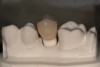 Fig 6. As seen in this image of the dental CAD software, the model and restorations were imported for final design details, demonstrating use of the ReShape concept.