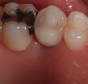 Fig 11. Intraoral postoperative view after cementation.