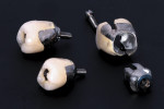 Figure 1. The removal of cement-retained implant restorations can be difficult and unpredictable, often requiring the destruction of the crown and/or the abutment.