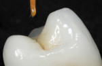 Figure 6. The prosthesis is placed on the abutment, then the brush is loaded with an opaque brown or white stain and lowered to the crown. Note the small concavity created on the occlusal surface to receive the stain; this ensures that the screw-access marking will not wear away under load.