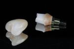 Figure 10. The definitive prosthesis and abutment ready for delivery.
