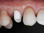 Figure 11. The definitive abutment is delivered and torqued to the specified
level.
