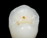 Figure 8. The screw-access marking clearly indicates the precise location of the screw access through the occlusal surface of the restoration. If the prosthesis needs to be removed at any future date, the screw can be easily and
predictably accessed by creating a hole at that location.